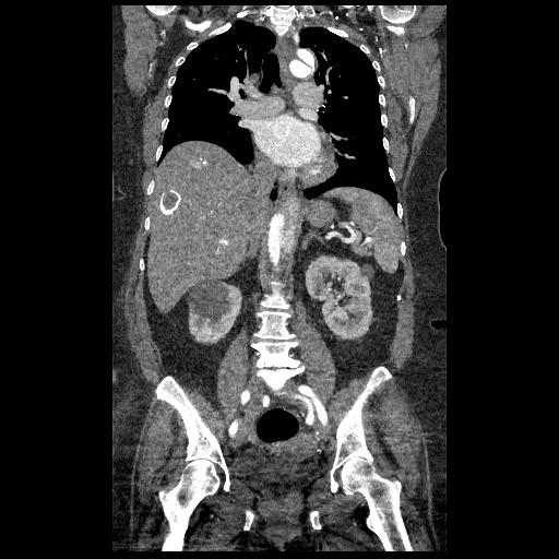 File:Aortic dissection - Stanford type B (Radiopaedia 88281-104910 B 43).jpg