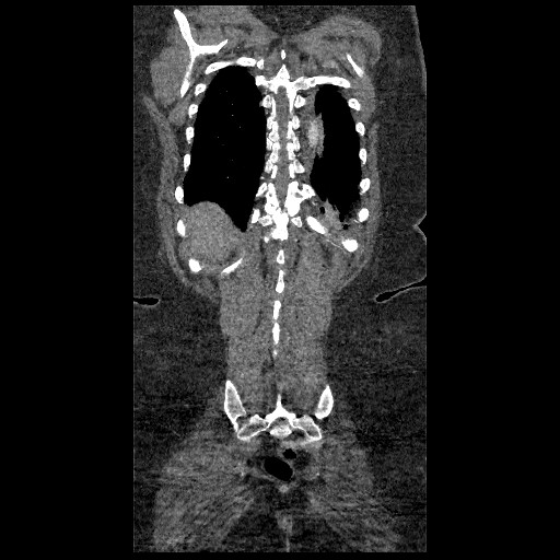 File:Aortic dissection - Stanford type B (Radiopaedia 88281-104910 B 78).jpg
