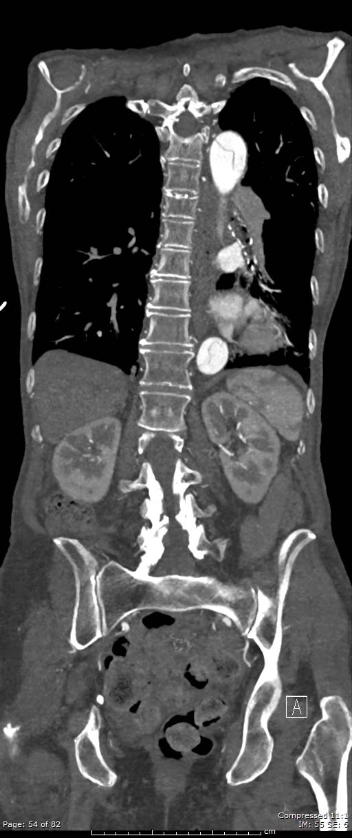 Aortic dissection with extension into aortic arch branches (Radiopaedia 64402-73204 A 54).jpg