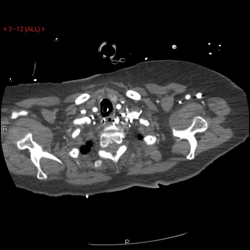 File:Aortic intramural hematoma (Radiopaedia 27746-28001 A 12).jpg