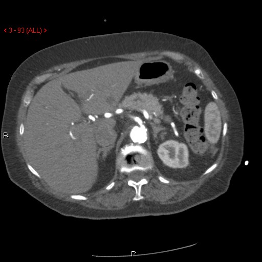 Aortic intramural hematoma (Radiopaedia 27746-28001 A 93).jpg
