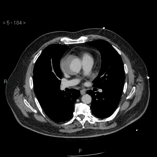 Aortic intramural hematoma (Radiopaedia 48463-53380 C 84).jpg