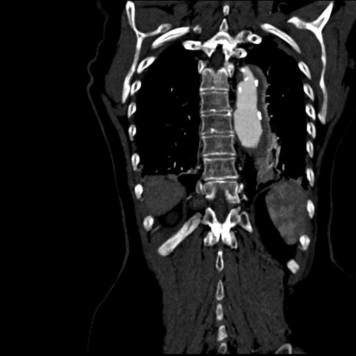 File:Aortic intramural hematoma from penetrating atherosclerotic ulcer (Radiopaedia 31137-31836 C 55).jpg