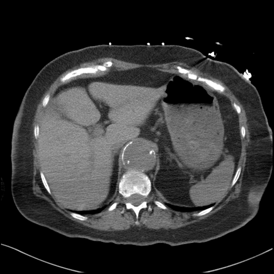 Aortic intramural hematoma with dissection and intramural blood pool (Radiopaedia 77373-89491 Axial non-contrast 94).jpg