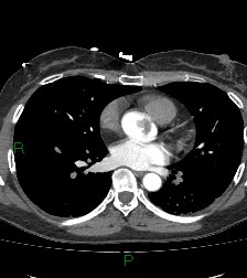 Aortic valve endocarditis (Radiopaedia 87209-103485 C 53).jpg