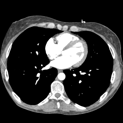 File:Aortic valve non-coronary cusp thrombus (Radiopaedia 55661-62189 A 44).png
