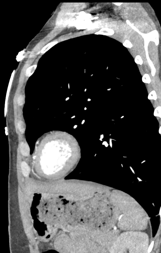 Aortic valve non-coronary cusp thrombus (Radiopaedia 55661-62189 C+ arterial phase 6).png