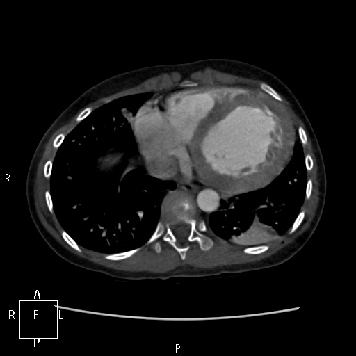 File:Aortopulmonary septal defect (Radiopaedia 41990-45013 Axial C+ CTPA 15).jpg
