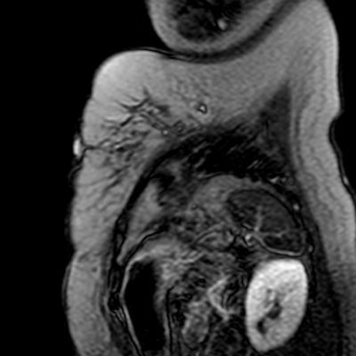 File:Apical hypertrophic cardiomyopathy (Radiopaedia 79346-92419 C 1).jpg