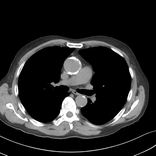 File:Apical pulmonary metastasis (Radiopaedia 46338-50754 B 30).png