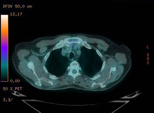 Appendiceal adenocarcinoma complicated by retroperitoneal abscess (Radiopaedia 58007-65041 Axial PET-CT 43).jpg