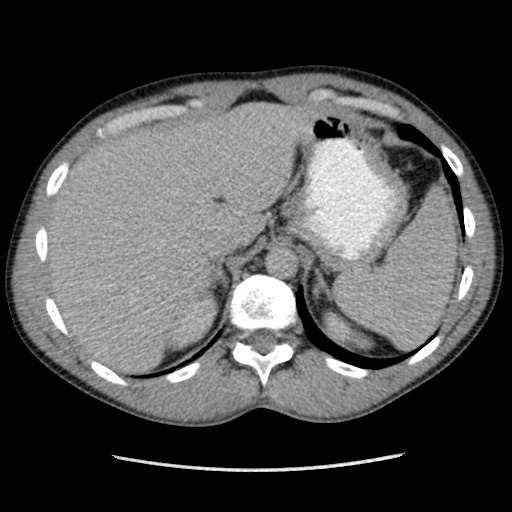 Appendicitis complicated by post-operative collection (Radiopaedia 35595-37113 A 12).jpg