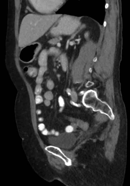 Appendicitis due to chicken fibula (Radiopaedia 74314-85198 C 61).jpg