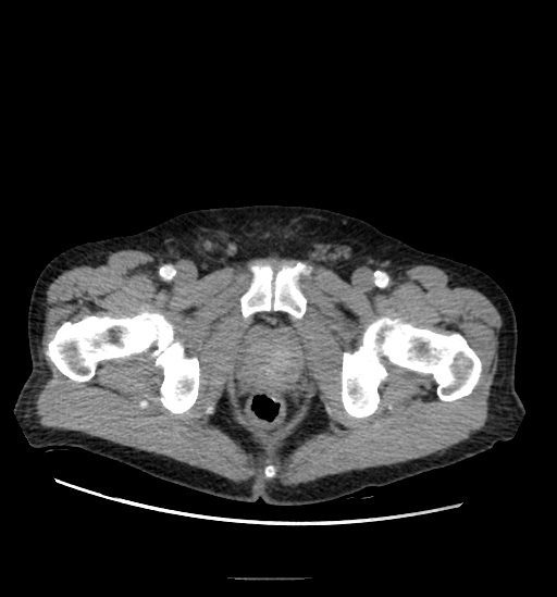 Appendicitis with localized perforation and abscess formation (Radiopaedia 49035-54130 A 86).jpg