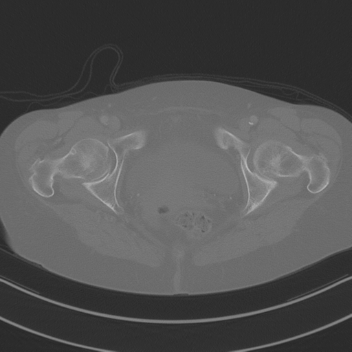 April fools' 2019- calcified peritoneal arachnoidosis (Radiopaedia 67273-76636 Axial bone window 56).png