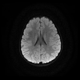 Arachnoid cyst - middle cranial fossa (Radiopaedia 86780-102938 Axial DWI 11).jpg