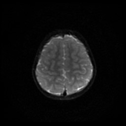 File:Arachnoid cyst - middle cranial fossa (Radiopaedia 86780-102938 Axial DWI 35).jpg