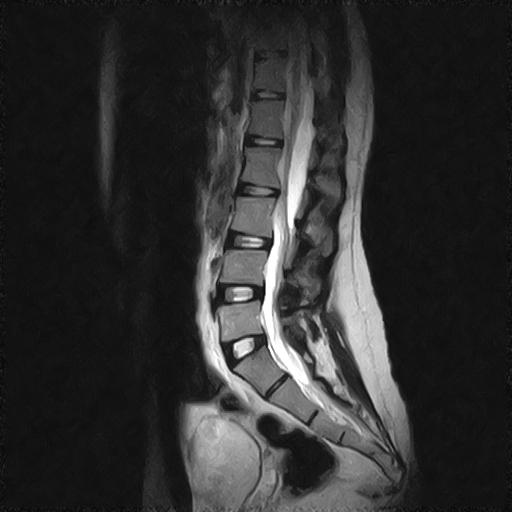 File:Arachnoid cyst - spinal (Radiopaedia 66835-76157 Sagittal T2 5).jpg