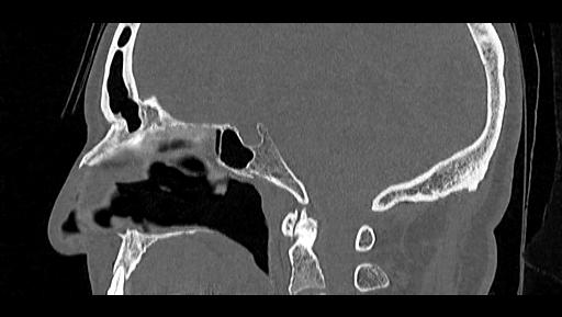 File:Arcuate foramen (Radiopaedia 89833-106944 Sagittal bone window 51).jpg