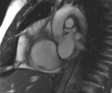 Arrhythmogenic right ventricular cardiomyopathy (Radiopaedia 69431-79307 Short axis cine 230).jpg
