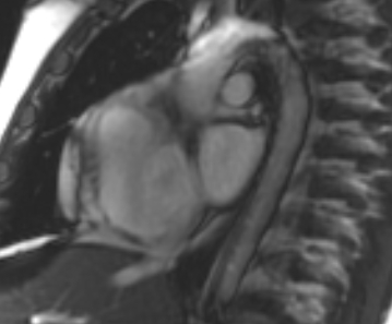 Arrhythmogenic right ventricular cardiomyopathy (Radiopaedia 69431-79307 Short axis cine 249).jpg