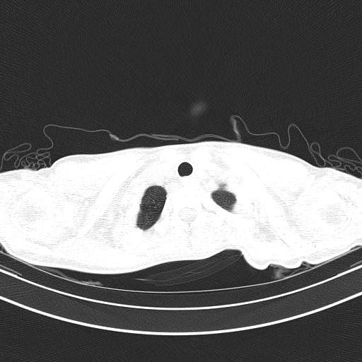 Arteria lusoria (Radiopaedia 88528-105192 Axial lung window 8).jpg