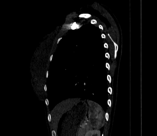Arteria lusoria (Radiopaedia 88528-105192 C 72).jpg