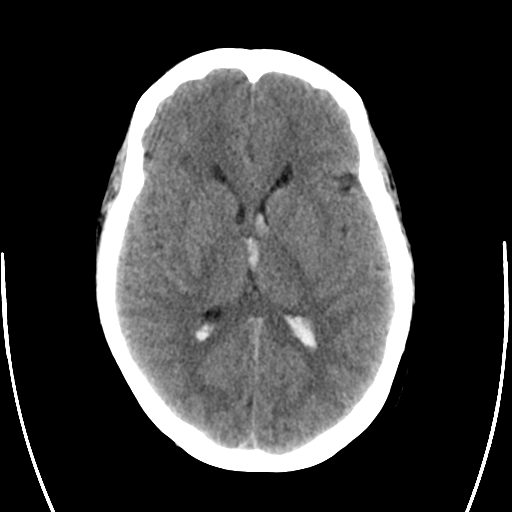 File:Arteriovenous malformation (cerebral) (Radiopaedia 40070-42579 Axial non-contrast 17).png