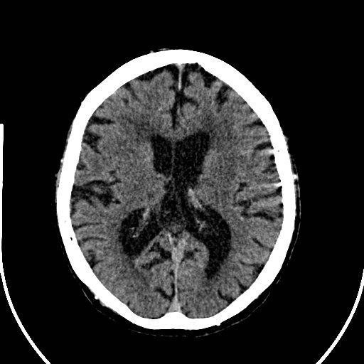File:Artery of Percheron infarction (Radiopaedia 26307-26438 Axial non-contrast 26).jpg