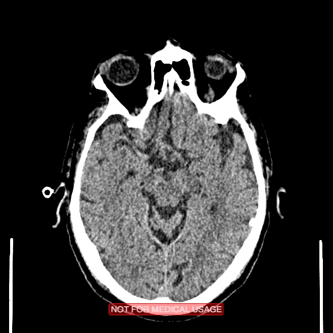 Artery of Percheron infarction (Radiopaedia 28679-28967 Axial non-contrast 49).jpg