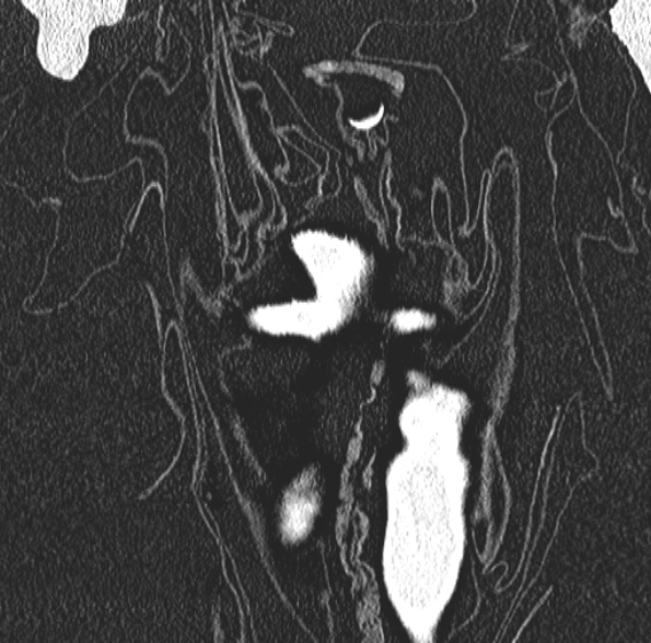 Aspergilloma- with Monod sign (Radiopaedia 44737-48532 Coronal lung window 101).jpg