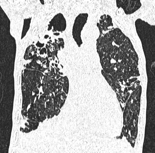 Aspergilloma- with Monod sign (Radiopaedia 44737-48532 Coronal lung window 218).jpg