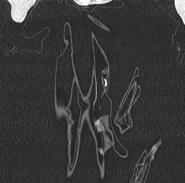 File:Aspergilloma- with Monod sign (Radiopaedia 44737-48532 Coronal lung window 69).jpg