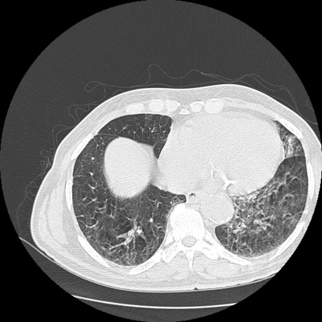 Aspergilloma (Radiopaedia 44592-48327 Axial lung window 68).jpg