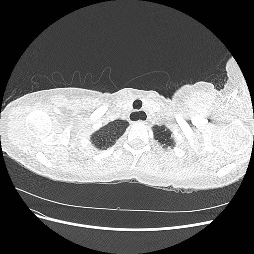 File:Aspiration pneumonia secondary to laparoscopic banding (Radiopaedia 18345-18183 lung window 3).jpg
