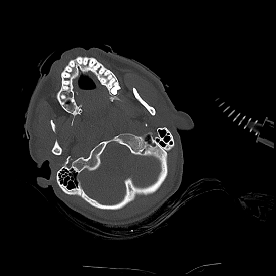 File:Atlanto-occipital dissociation (Traynelis type 1), C2 teardrop fracture, C6-7 facet joint dislocation (Radiopaedia 87655-104061 Axial bone window 12).jpg