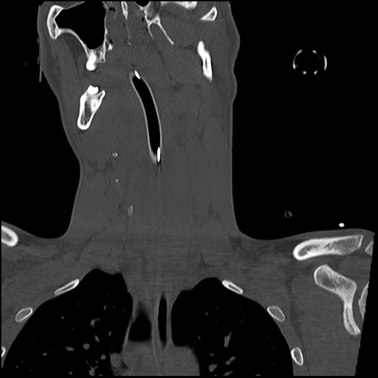 Atlanto-occipital dissociation (Traynelis type 1), C2 teardrop fracture, C6-7 facet joint dislocation (Radiopaedia 87655-104061 Coronal bone window 28).jpg