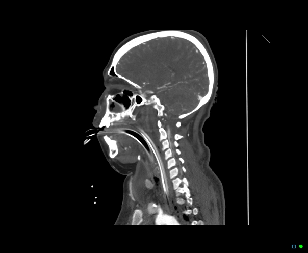 Atlanto-occipital dissociation - Traynelis type 1 (Radiopaedia 87570-103949 C 36).jpg