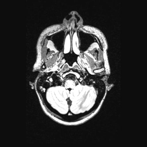 Atretic encephalocoele with inferior vermis hypoplasia (Radiopaedia 30443-31108 Axial 31).jpg