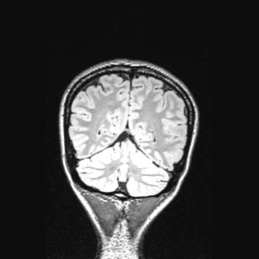 Atretic encephalocoele with inferior vermis hypoplasia (Radiopaedia 30443-31108 Coronal FLAIR 48).jpg