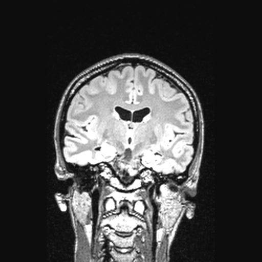 Atretic encephalocoele with inferior vermis hypoplasia (Radiopaedia 30443-31108 Coronal FLAIR 97).jpg