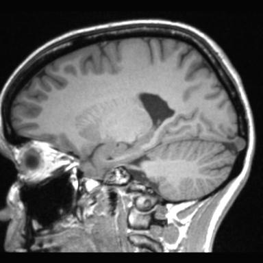 Atretic encephalocoele with inferior vermis hypoplasia (Radiopaedia 30443-31108 Sagittal T1 84).jpg