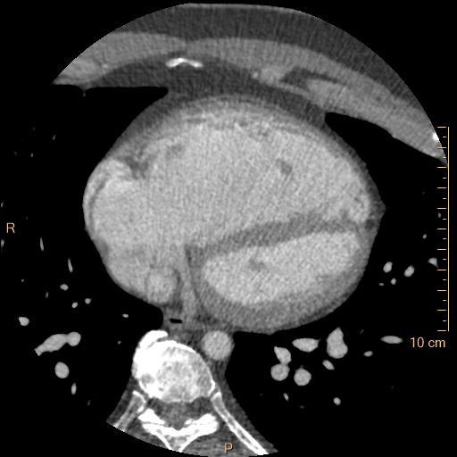 Atrial septal defect (upper sinus venosus type) with partial anomalous pulmonary venous return into superior vena cava (Radiopaedia 73228-83961 A 184).jpg