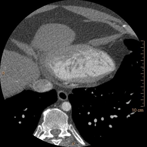Atrial septal defect (upper sinus venosus type) with partial anomalous pulmonary venous return into superior vena cava (Radiopaedia 73228-83961 A 237).jpg