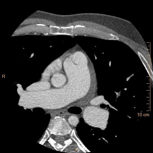 Atrial septal defect (upper sinus venosus type) with partial anomalous pulmonary venous return into superior vena cava (Radiopaedia 73228-83961 A 74).jpg