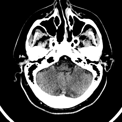 File:Atypical meningioma (WHO grade II) with brain invasion (Radiopaedia 57767-64728 Axial C+ 45).png