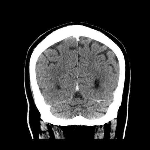 Atypical meningioma (WHO grade II) with brain invasion (Radiopaedia 57767-64728 Coronal C+ 50).png