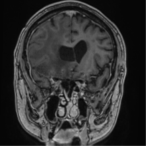 Atypical meningioma (WHO grade II) with brain invasion (Radiopaedia 57767-64729 Coronal T1 C+ 28).png