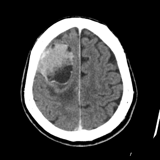 Atypical meningioma (WHO grade II) with osseous invasion (Radiopaedia 53654-59715 Axial C+ delayed 41).png