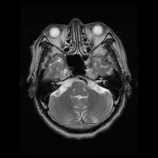 File:Atypical meningioma (WHO grade II) with osseous invasion (Radiopaedia 53654-59716 Axial T2 5).png